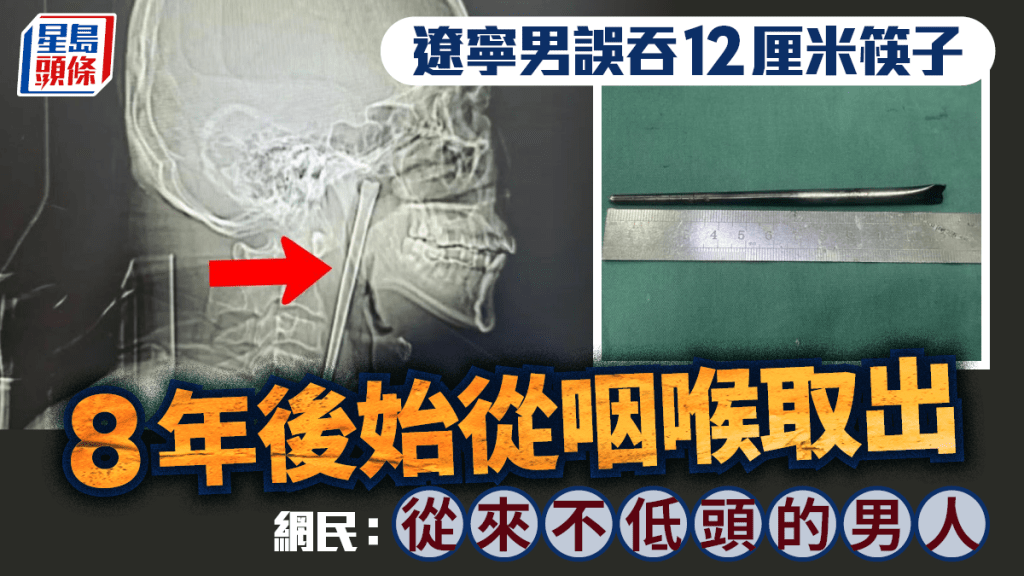 遼寧大叔誤吞12cm筷子8年後始取出   網民：從來不低頭