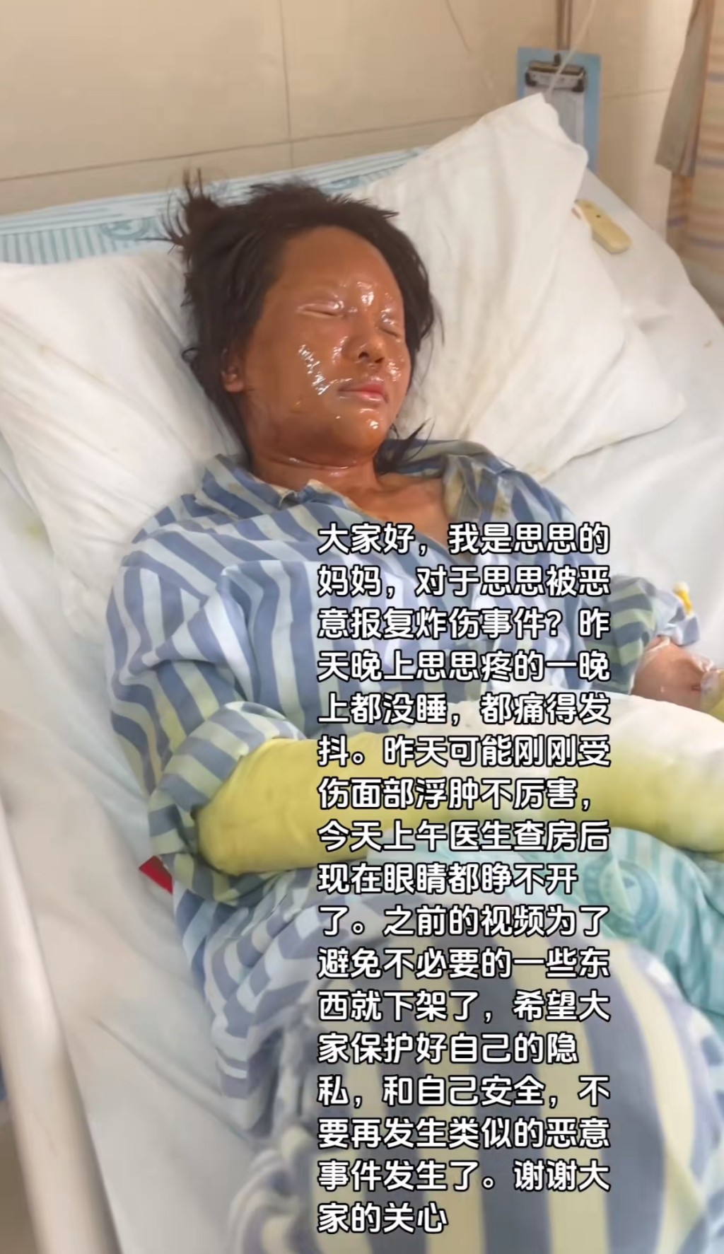 湖南女主播遭包裹炸傷毀容。抖音@思思Alora 湖南女主播遭包裹炸傷毀容。抖音@思思Alora