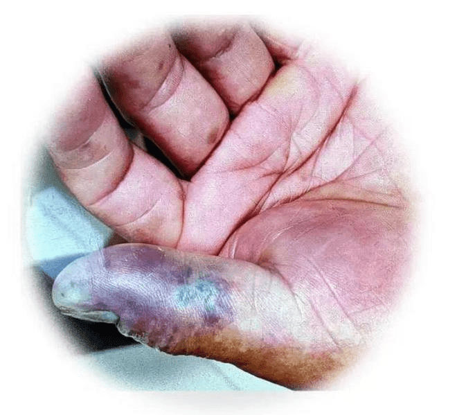 沈伯清洗小龙虾时左手大拇指被虾枪刺伤，隔天受伤的拇指开始肿胀，皮肤发黑。
