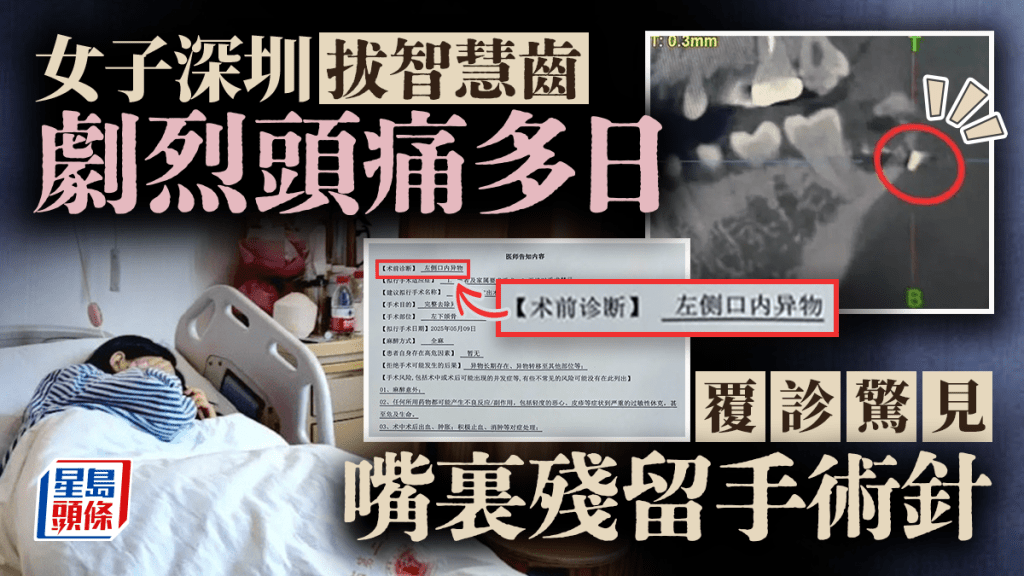 深圳女拔智齒後劇烈頭痛多日,覆診驚見「嘴裡殘留手術針」。