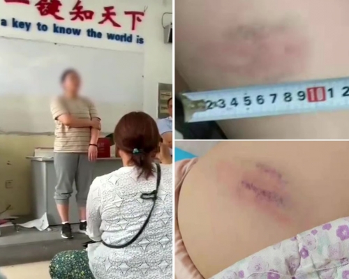 小學體育老師棍打全班54名學生，屁股上有明顯傷痕。（網圖）