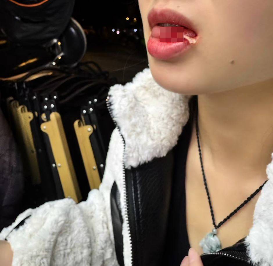 羅小姐吃黃辣丁魚時被其背鯺硬刺插入舌頭，連跑3間醫院才成功「拔骨」。抖音＠獨美