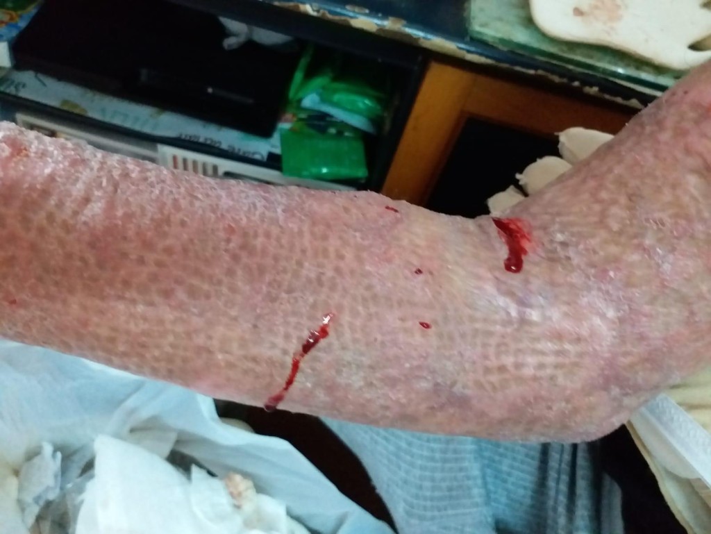 李生表示被燒傷皮膚的癒合狀況比以前好,但脫下緊身衣時仍會流血。資料圖片