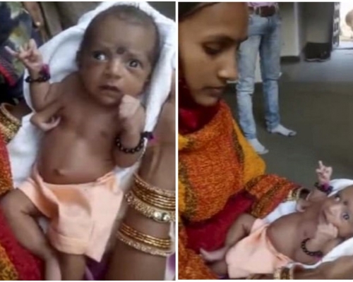 女嬰胸前長出「第三隻手」。網圖