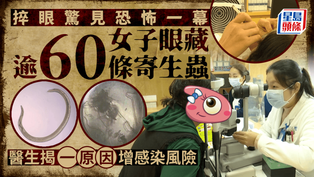 昆明女子雙眼藏60多條活生生寄生蟲，多到揉眼睛都掉出蟲。