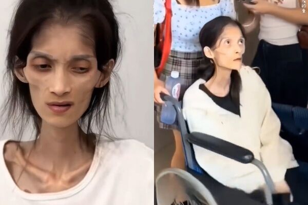 27岁女孩巧巧去世，此前她因患胃萎缩，体重仅剩17kg。