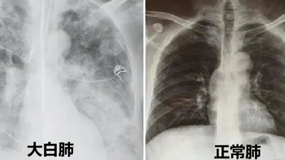 白色肺X光片引起變異致命病毒恐慌。