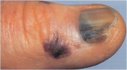 黃種人黑色素瘤好發於四肢末端。