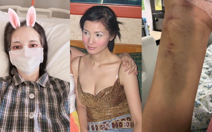 鄭艷麗自拍臥病床及抽血等隻手瘀黑照。