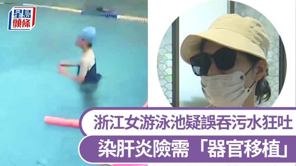 浙江女游泳池疑誤吞污水狂吐，1天瘦4公斤，染肝炎險需「器官移植」。