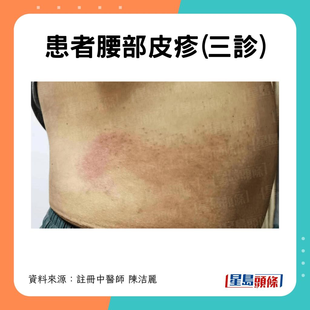 三診時腰部皮疹