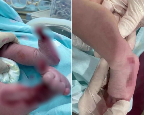 深圳一名初生嬰先天性皮膚發育不全，露出肌肉。