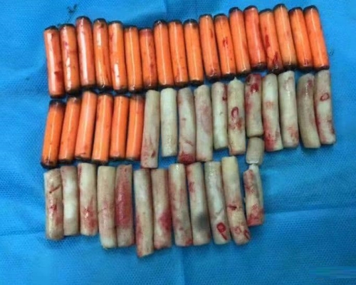 貴州男子取出47節塑膠管及芋頭。網上圖片