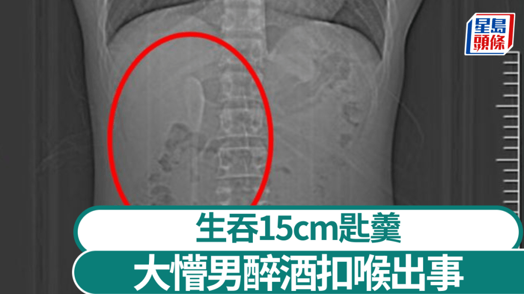 內地男子到泰國旅遊期間，因醉酒扣喉誤吞15cm匙羹。上觀新聞