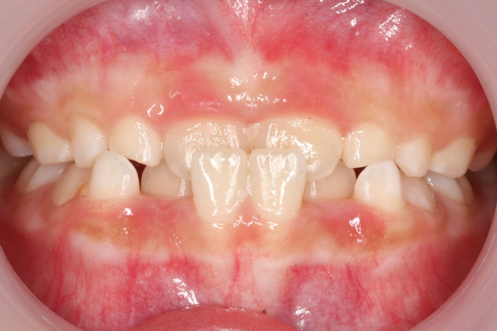兒童箍牙︳一名有倒及牙的7歲女童，治療 前後的對比照。（前）（圖片來源：由受訪者提供）