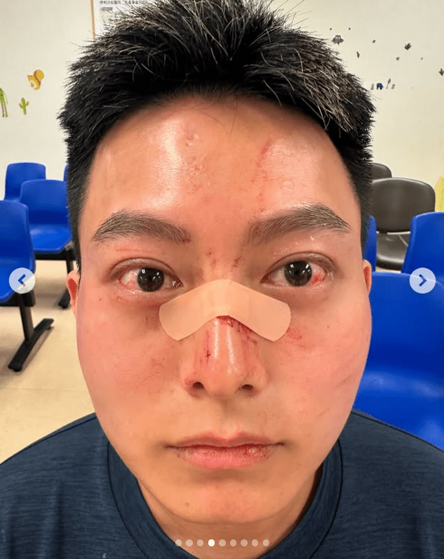 葉子健事後於社交平台展示傷勢。葉子健IG 葉子健事後於社交平台展示傷勢。葉子健IG