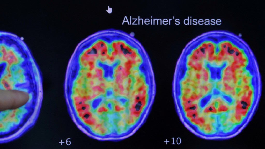 医生指出脑部扫瞄显示患有阿兹海默症的位置。 路透社