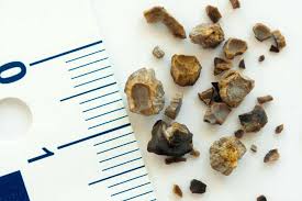 肾石有大有小，小的是可以自己排除体外的。