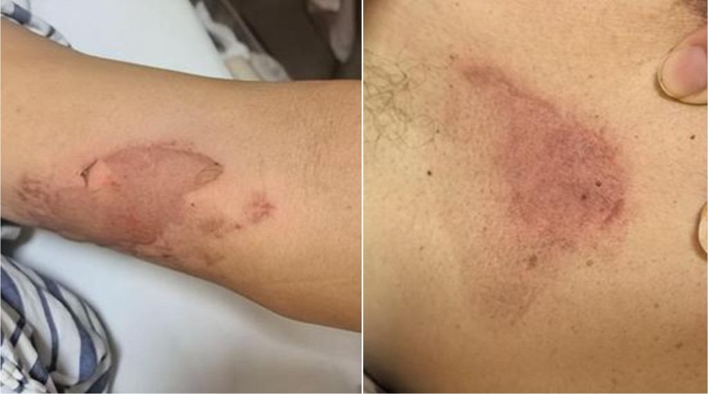 浙江女用乾冰助六旬父退燒，反致其一身水泡紅腫。澎湃新聞