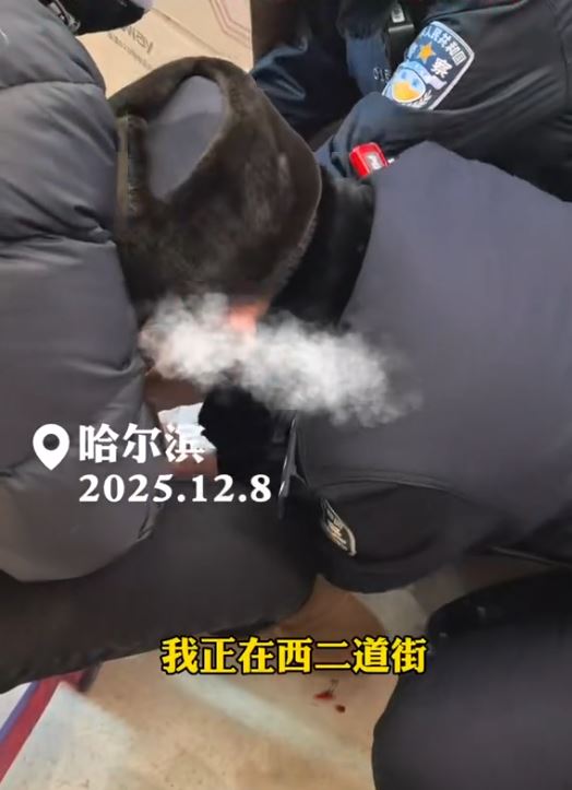 南方遊客未著打底褲，在哈爾濱-20℃氣溫下，凍爆靜脈曲張的血管。平安哈爾濱