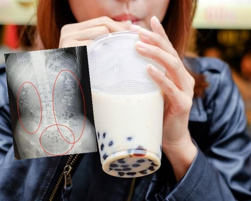 少女喝珍珠奶茶後,便秘5日及感到肚子疼痛。示意網圖/網圖