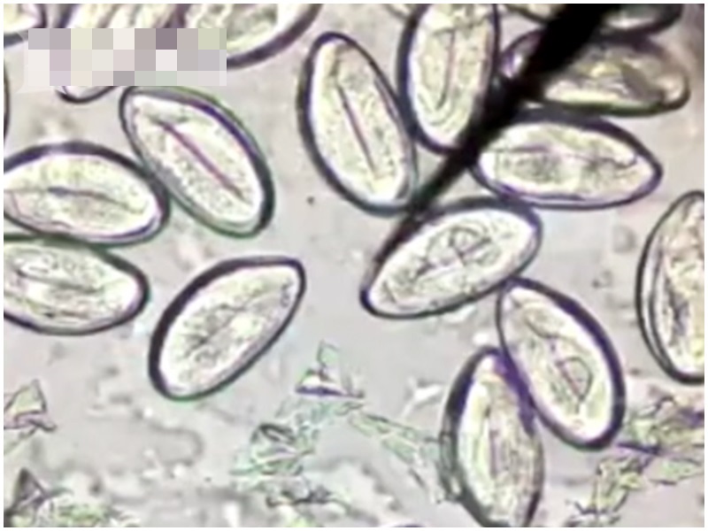 男子肝部充滿寄生蟲。網圖