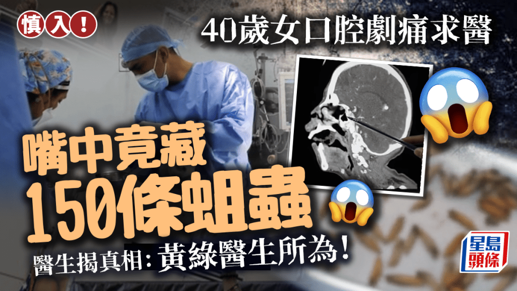 40歲女子口腔劇痛 醫生驚揭嘴中藏150條蛆蟲