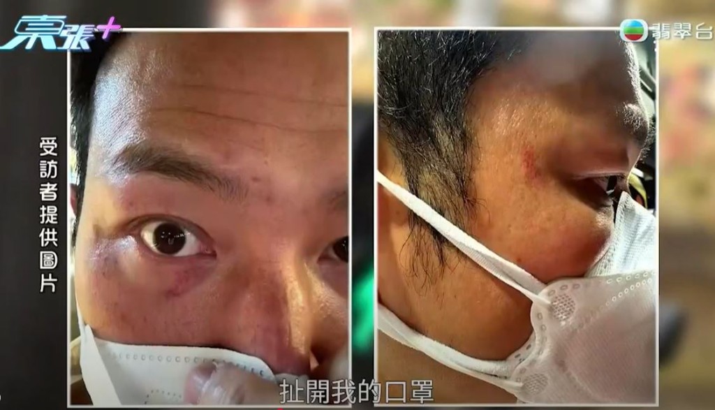 趙敏通眼角受傷。《東張西望》截圖