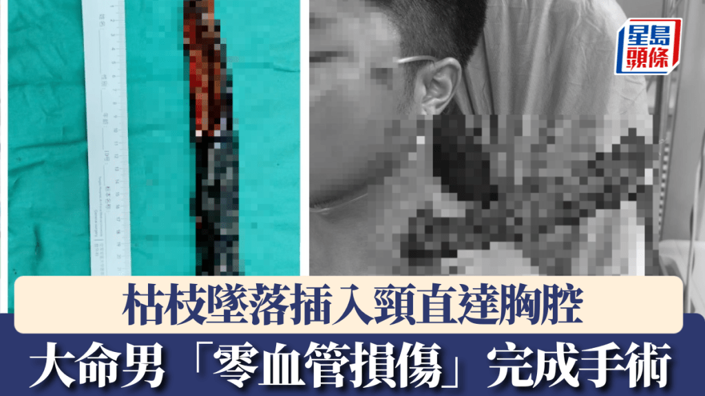 枯枝墜落插入頸直達胸腔12cm深，大命男「零血管損傷」完成手術。