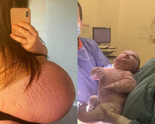 21歲母誕英史上第2重巨嬰，孕肚太大滿佈妊娠紋幾乎完全裂開。