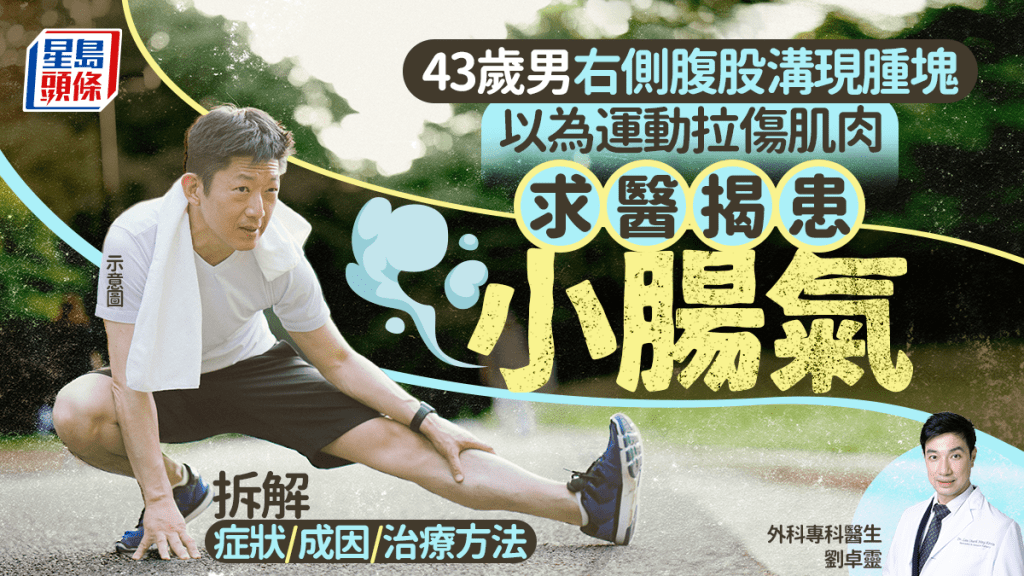 43歲男右側腹股溝現腫塊 以為運動拉傷肌肉 求醫揭患小腸氣 醫生拆解症狀/成因/治療方法
