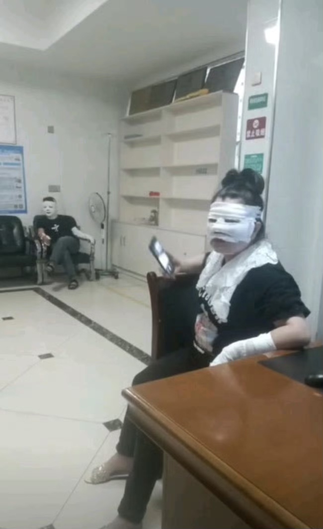 野外燒烤遇卡式爐爆炸多人被炸傷。微博@嗒啵菲 野外燒烤遇卡式爐爆炸多人被炸傷。微博@嗒啵菲