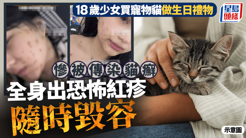 貓癬皮膚病︱18歲少女買寵物貓「生日禮物」  全身出恐怖紅疹隨時毀容