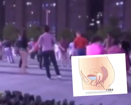 醫生經檢查後,發現她患有「子宮脫垂」,而掉出的肉色物體則是其子宮。網圖