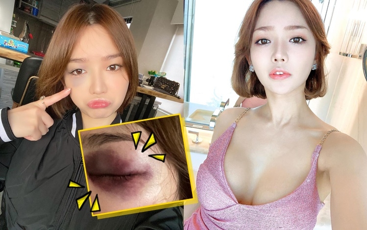 Kiwi日前意外撞傷隻眼。