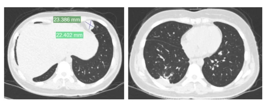 夏夏複查查出癌症轉移到肺部。