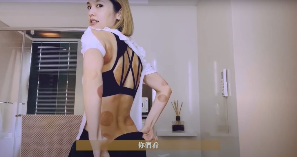 丞琳又分享拔罐經歷，玉背出現多個紅印。