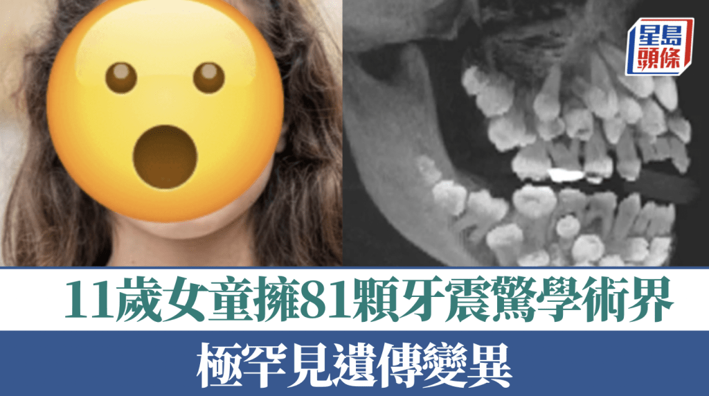 Alamy示意圖 /《美國正畸與牙面骨科雜誌》