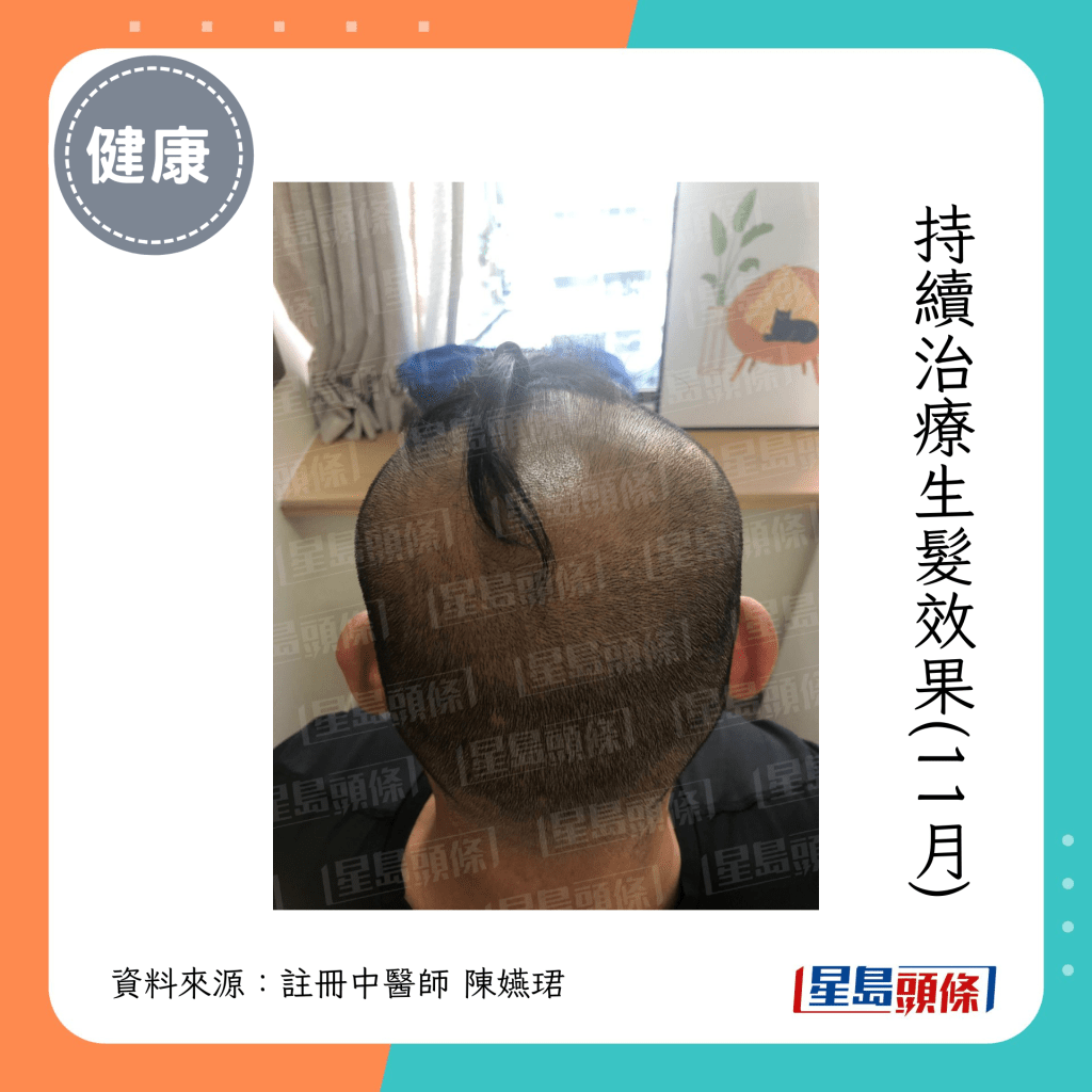 男子持续治疗，头发的再生情况（注册中医师陈嬿珺提供）