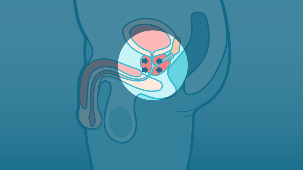 前列腺肥大會壓著尿道。
