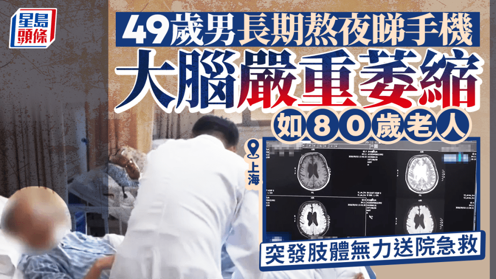 上海49歲男長期熬夜刷手機  大腦嚴重萎縮如80歲老人