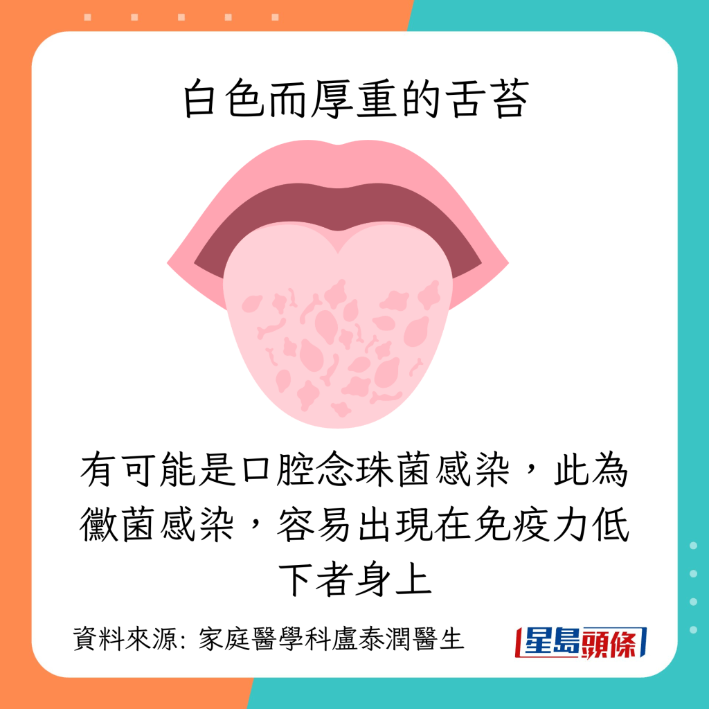 白色舌苔：口腔念珠菌感染