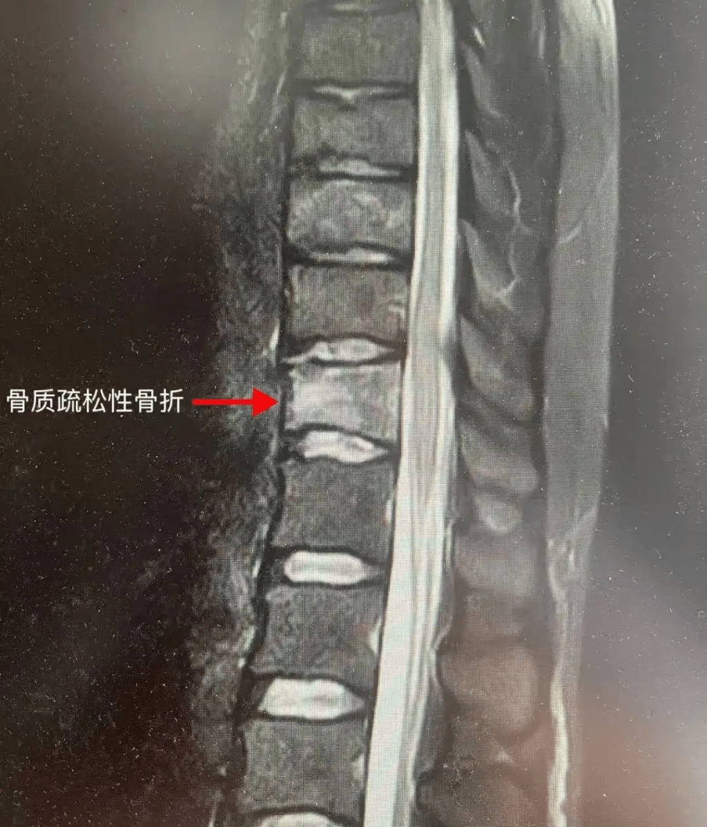 25歲後生女患骨質疏鬆。