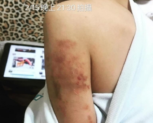 被虐學童手上瘀青相當明顯。網上圖片