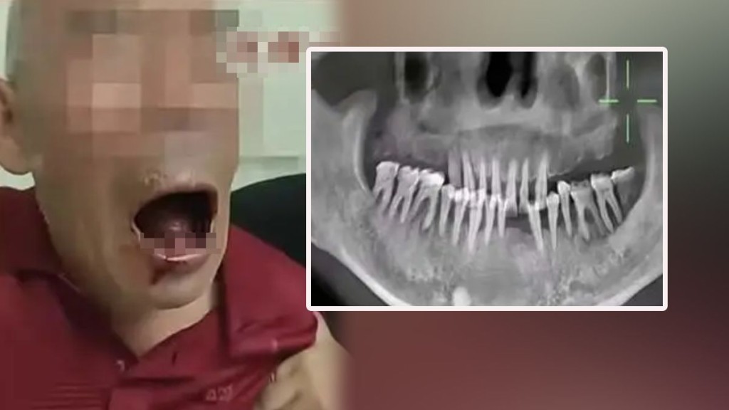 涉事老翁兩日內被掉口腔內21顆牙齒。