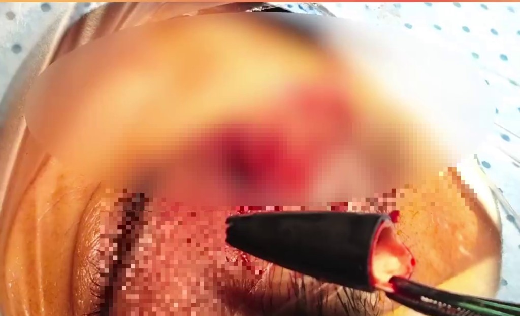 医生从眼眶内取出2.5厘米笔头。