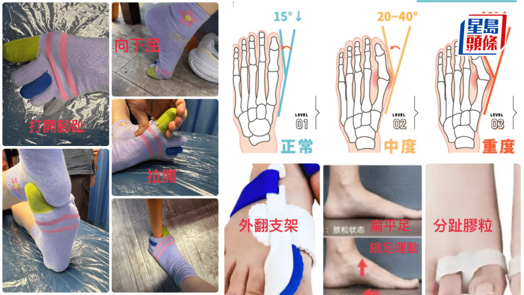 拇趾外翻，身體「基石」不穩。圖片由筆者提供
