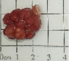 管狀絨毛狀的腺瘤（圖片由受訪者提供）