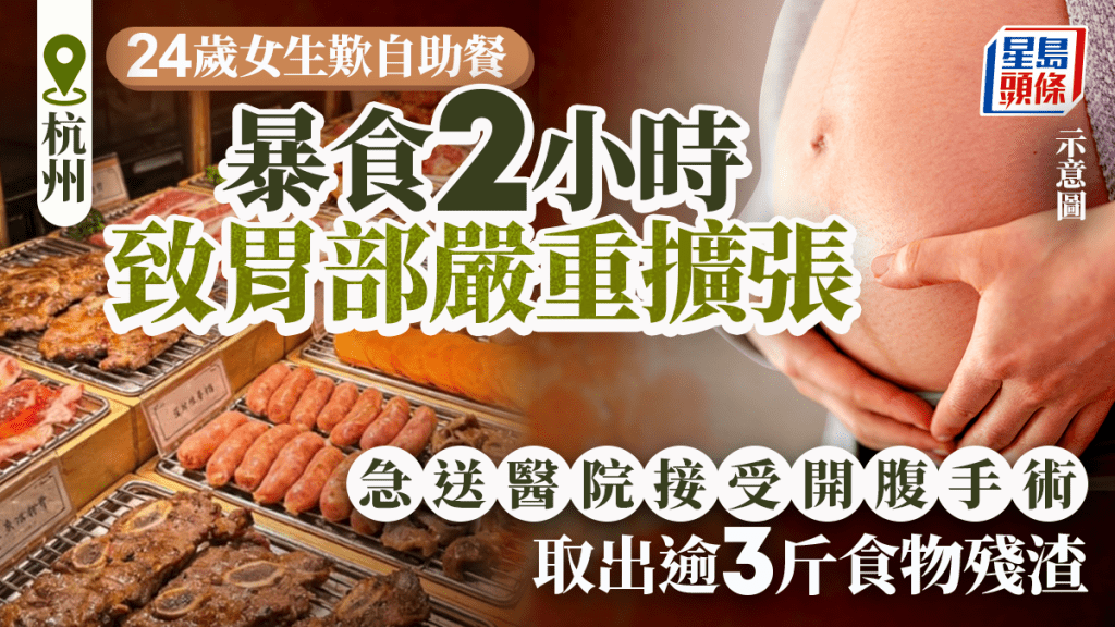 杭州24歲女自助餐狂食2個鐘肚脹如波  無法消化開刀取逾3磅殘渣
