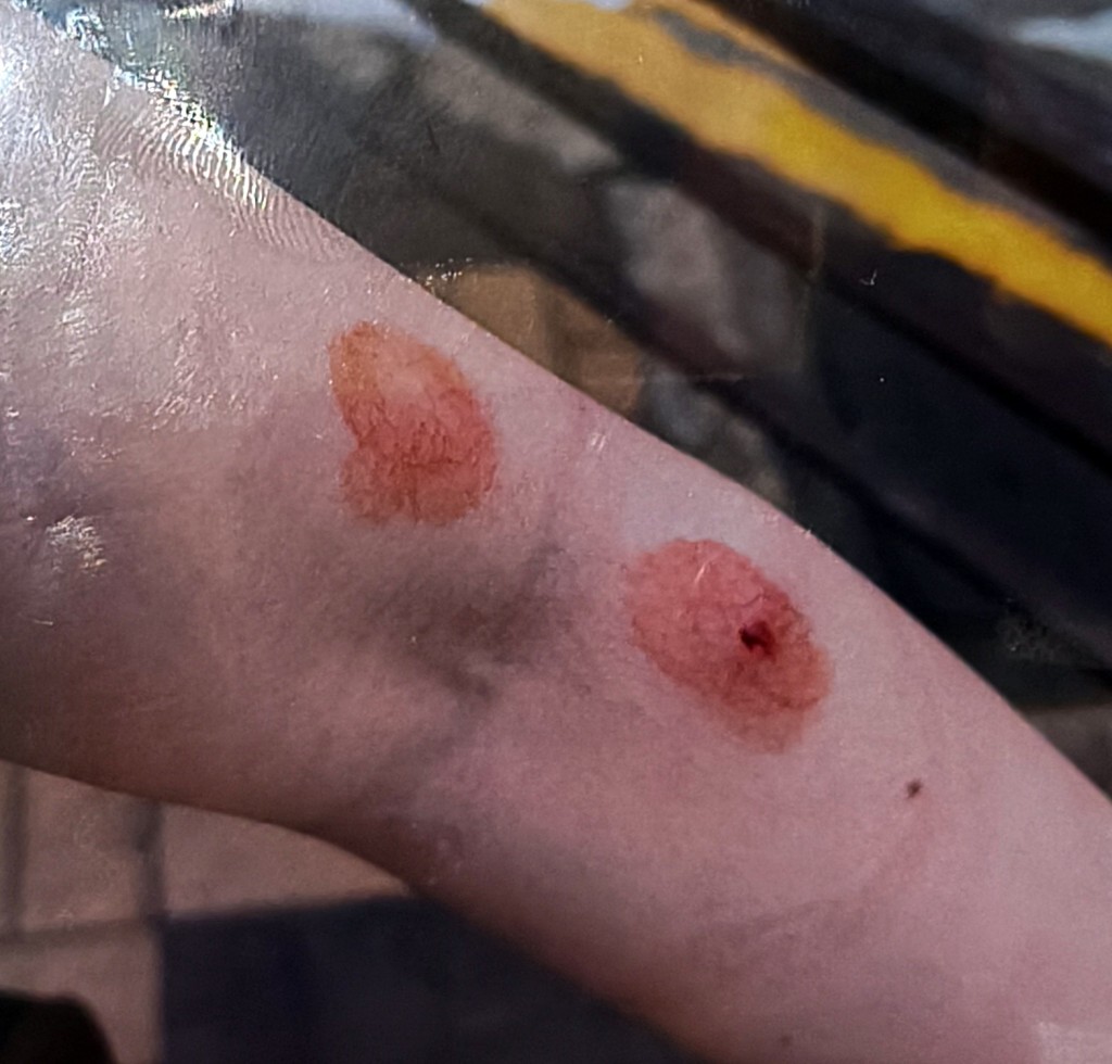 女傷者手臂被利剪刺傷。(傷者朋友提供) 女傷者手臂被利剪刺傷。(傷者朋友提供)